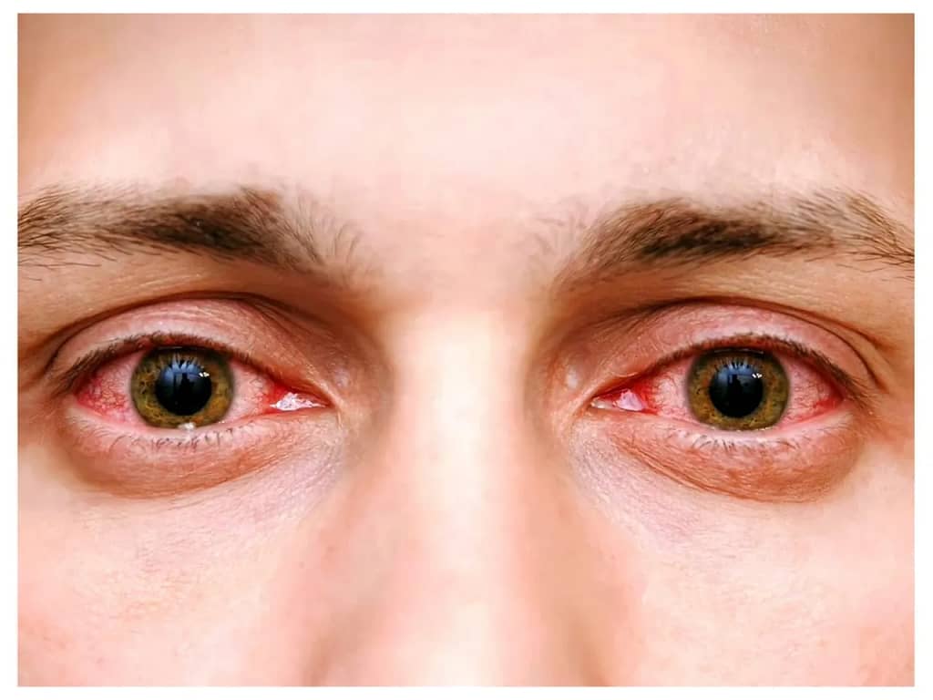 डोळे का येतात ? त्याची लक्षणे व कारणे आणि घरगुती उपाय-Conjunctivitis Home Remedies